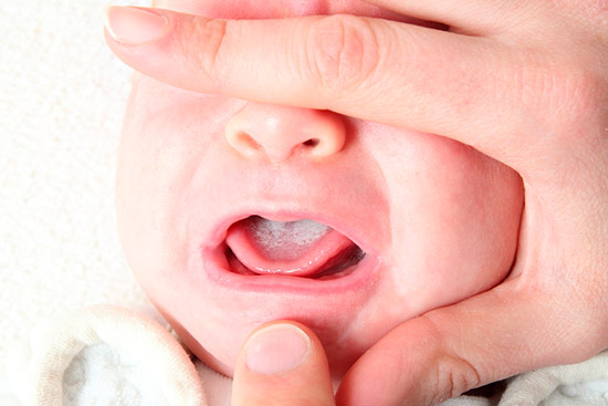 Qué el muguet o manchas en la boca del bebé? - y Caricias
